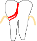 Gespaltener Zahn Reparieren